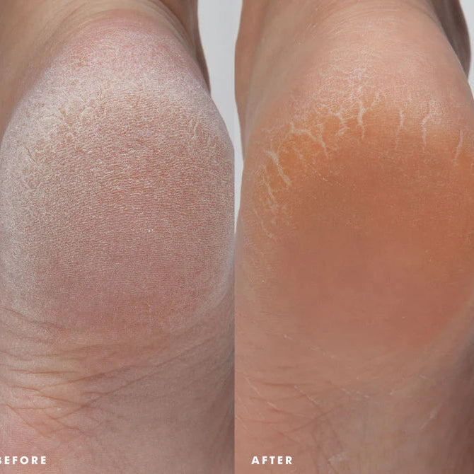 Enrich Mint® Foot Rescue Mask